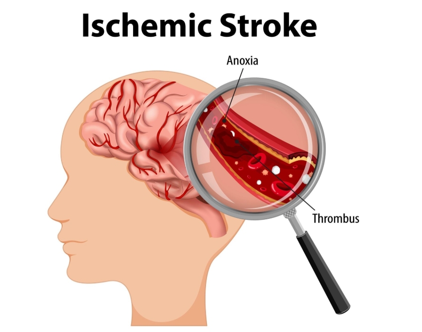 BRAIN STROKE TREATMENT